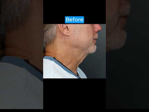 AMAZING NECKLIFT TRANSFORMATION