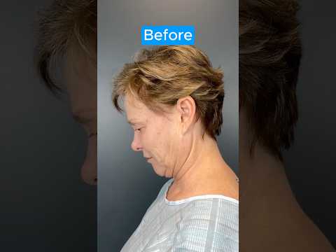 HUGE NECKLIFT TRANSFORMATION #facelift