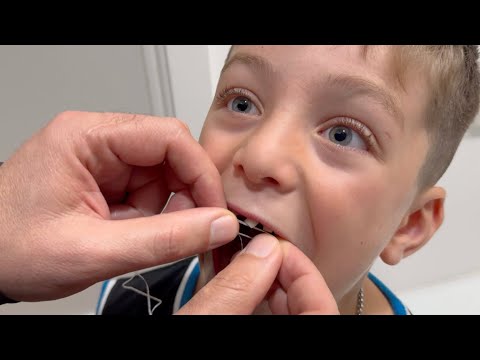 How to Pull a Loose Tooth 🦷 Losing a Baby Tooth 😁 Health Stories