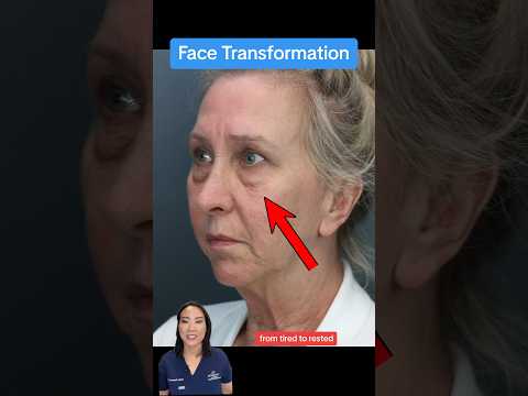 FROM TIRED TO WELL RESTED (BEFORE AFTER) #eyelidsurgery