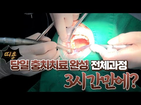 3시간 완성 당일 충치(보철)치료 전체과정