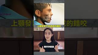 牙齒矯正黃金年齡是幾歲？等乳牙換完還是提早矯正好#牙齒矯正#兒童矯正