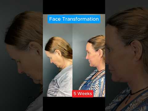 Amazing 5 Week Facelift Transformation #facelift