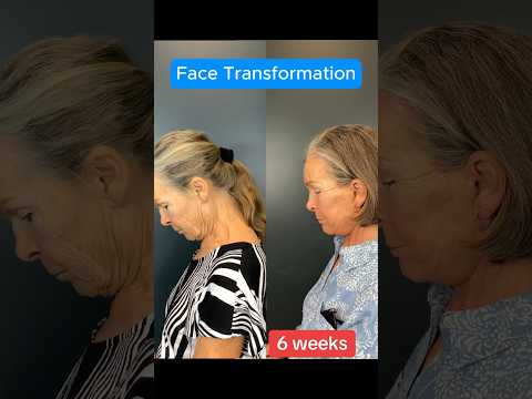 6 Week Update Facelift Transformation (Surgeon Reacts) #facelift