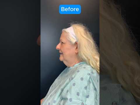 UNREAL Facelift Transformation (BEFORE AFTER) #facelift