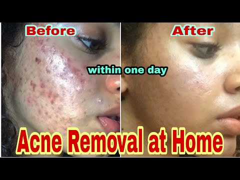 Acne Removal Face Mask Over One Night || ACNE TREATMENT AT HOME || Mask for ACNE PRON SKIN | Be Glam