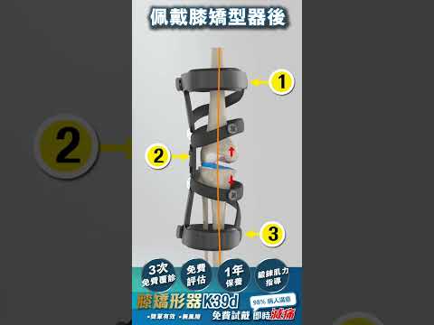 動態診斷及動態矯形O型膝痛 #kneepainexercises #牽引  #物理治療 #O型腳