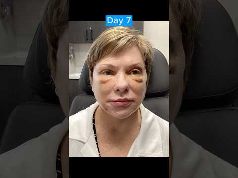 AMAZING FACELIFT JOURNEY TRANSFORMATION