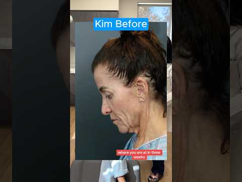 *PART 2* 3 Week Facelift Update (Interview)