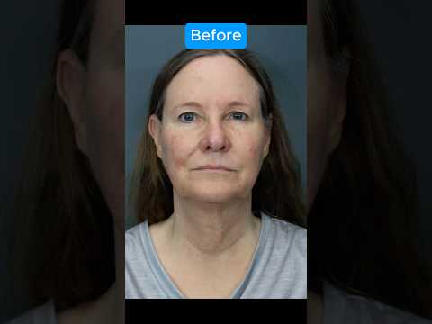 INSANE FACELIFT TRANSFORMATION (Journey)