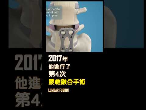 【自診自醫】著名高爾夫球手的腰椎手術為何做完又做?(B18a/B18b)(3D Animation)