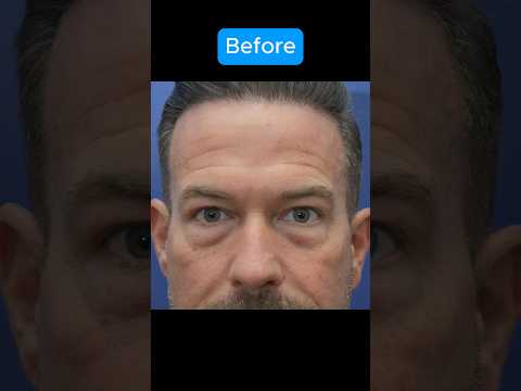 HUGE EYELID TRANSFORMATION #blepharoplasty