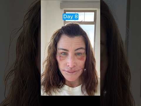 EPIC FACELIFT TRANSFORMATION UPDATE (Journey)