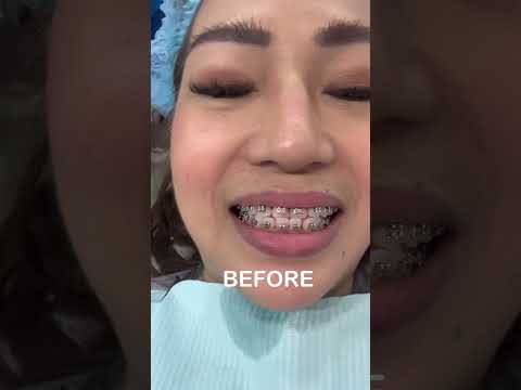 BRACES 3rd adjustment👍 #braces #Toothinthemaking #orthodontist #shorts #shortvideo #wow #dentalcare