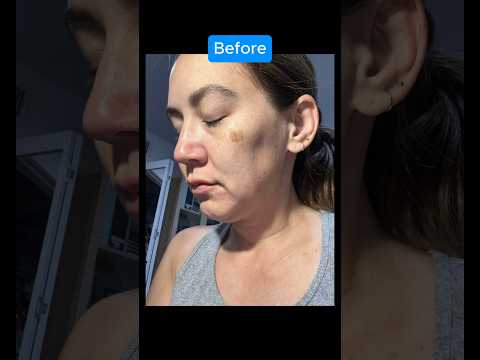 EPIC 1 YEAR FACELIFT TRANSFORMATION (Journey)