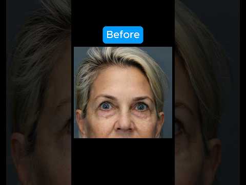 AMAZING EYELID TRANSFORMATION #blepharoplasty