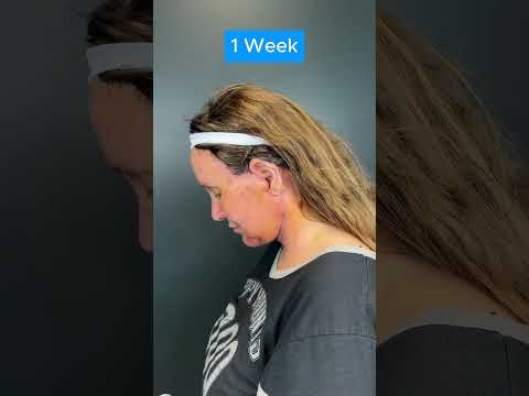 HUGE FACELIFT TRANSFORMATION (2 Week Update)