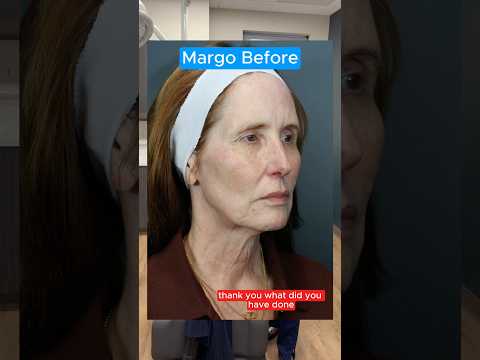 Facelift 1 Month Update (Interview)