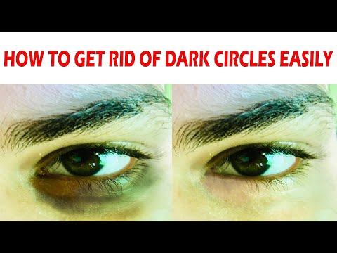 BYE-BYE DARK CIRCLES || HOW TO GET RID OF DARK CIRCLES IN JUST 7 DAYS  || EASIEST HOMEMADE REMEDIES