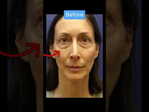 Insane Face Transformation!! (BEFORE AFTER) #blepharoplasty