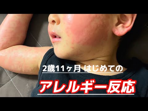 【初めてのアレルギー反応】vlogのはずが…40度超え…🤒