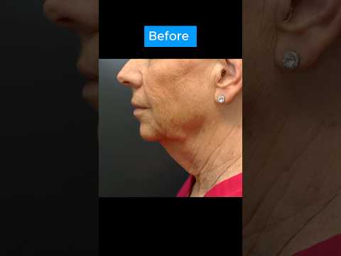 AMAZING NECKLIFT TRANSFORMATION