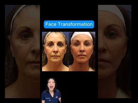 ✅ This is BEYOND Facelift (NO FILLERS)