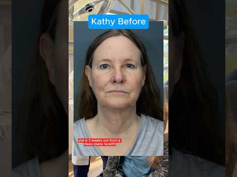 The Real Facelift Results After 3 Weeks (Interview)