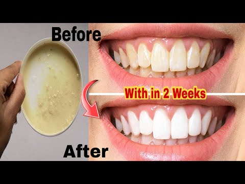 Easy Teeth Whitening at Home| Within 2 weeks permanently| Natural way to Whitening Teeth