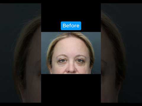 INCREDIBLE Transformation #blepharoplasty