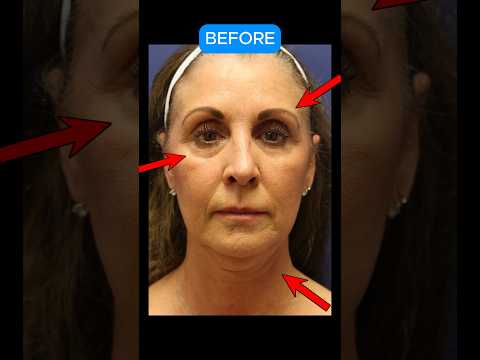 STUNNING Facelift Transformation! #facelift