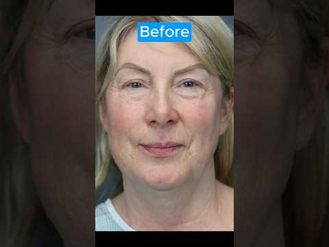 AMAZING TRANSFORMATION #blepharoplasty