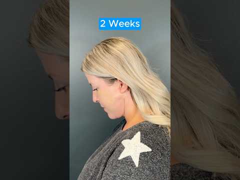 EPIC NECK LIFT TRANSFORMATION