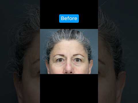 HUGE TRANSFORMATION #blepharoplasty