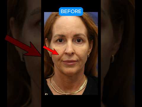 1 Year Facelift Transformation (BEFORE AFTER) #facelift