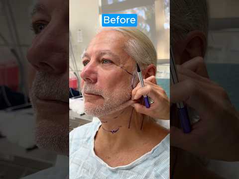 AMAZING DEEP NECKLIFT JOURNEY