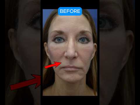 HUGE Lip Lift & Lip Augmentation #liplift