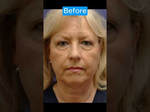 BROWLIFT TRANSFORMATION #blepharoplasty