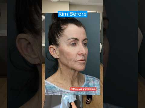 The EPIC Facelift 3 Week Update (Interview)