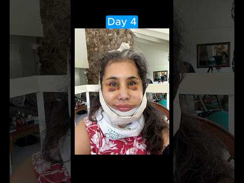 INCREDIBLE FACELIFT TRANSFORMATION (Journey)