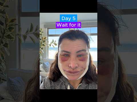 EPIC FACELIFT TRANSFORMATION (Journey)