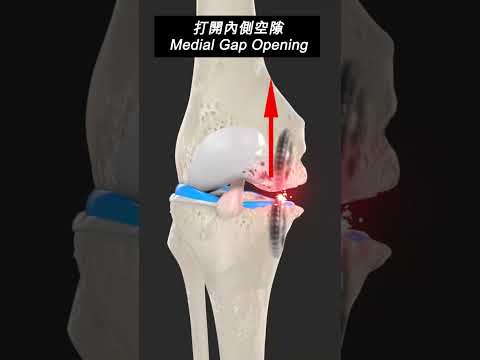 解決O型膝痛  Pain Relief OA Knee