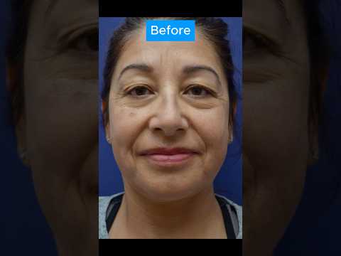 AMAZING TRANSFORMATION #blepharoplasty