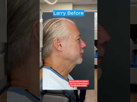 Deep Neck Facelift 2 Weeks (Interview)