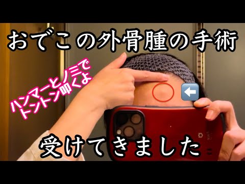 【おでこの外骨腫手術・局所麻酔】15年放置してきた骨腫をようやく切除！前額部外骨腫切除・摘出術！一連の流れ