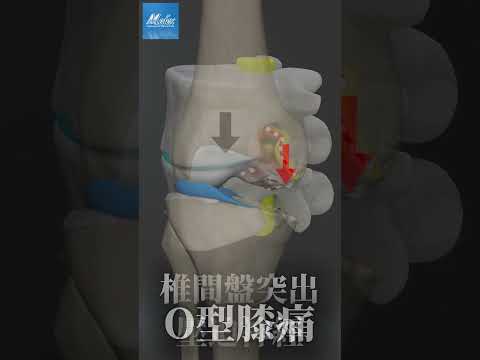 【機械性疾病，知多少?】(Mechanical Diseases)