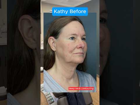 The Real Facelift Results After 5 Weeks (Interview)