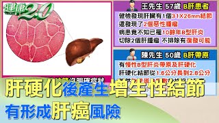 肝硬化後產生增生性結節 有形成肝癌風險 健康2.0