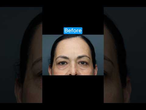 INCREDIBLE Natural Transformation #blepharoplasty