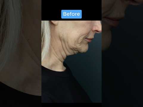 INSANE NECKLIFT TRANSFORMATION